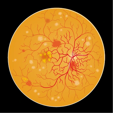 diabetic retinopathy